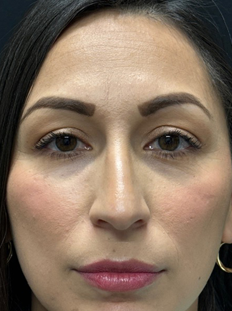 Rhinoplasty before and after - before