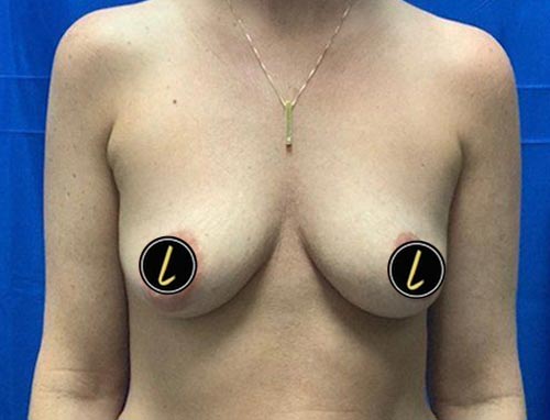 Breast Augmentation before and after - before