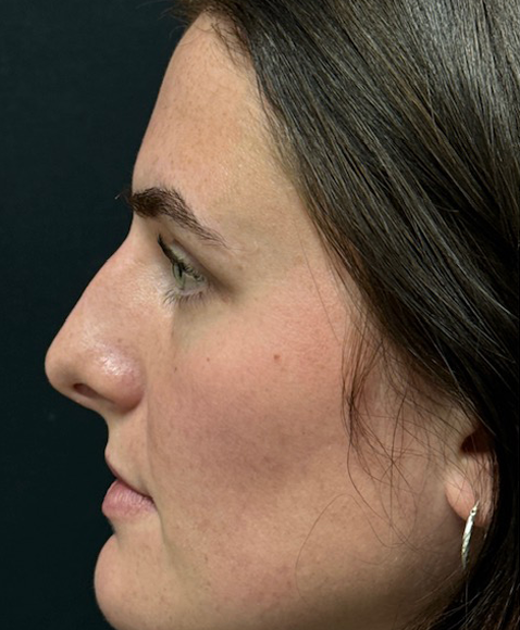 Rhinoplasty before and after - before