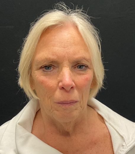 Facelift before and after - before