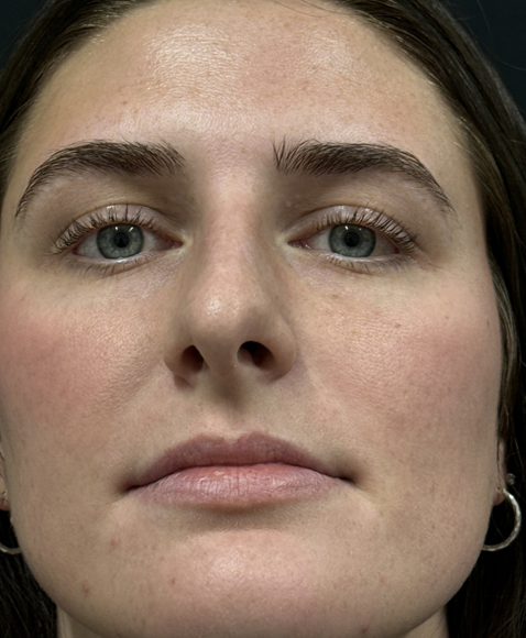 Rhinoplasty before and after - before