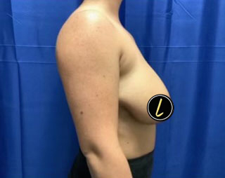 Breast Lift before and after - before