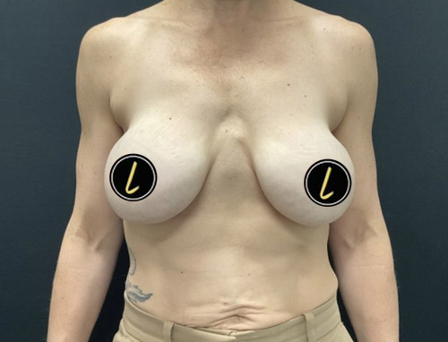 Breast Revision before and after - before
