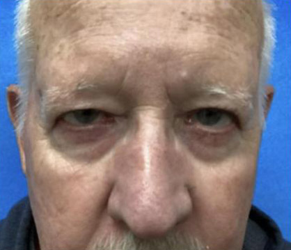 Male Blepharoplasty before and after - before