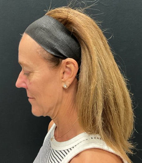 Facelift before and after - before