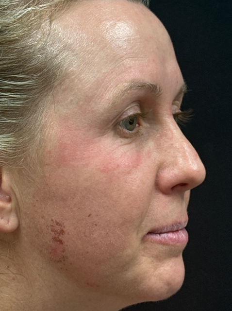 Rhinoplasty before and after - before