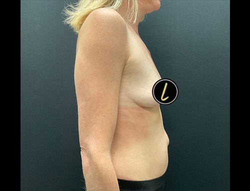 Breast Augmentation before and after - before