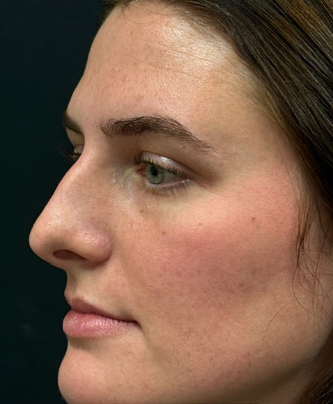 Rhinoplasty before and after - before