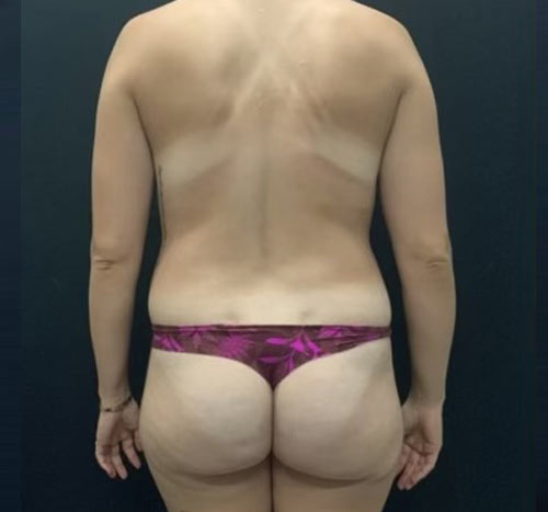 Mommy Makeover before and after - before