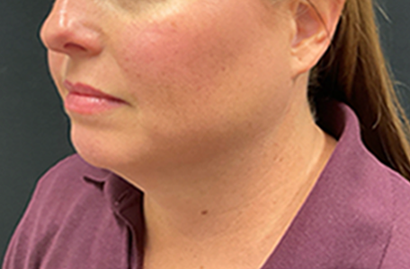 Facelift before and after - before