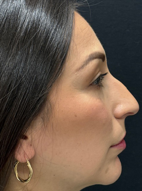 Rhinoplasty before and after - before