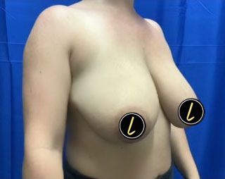 Breast Lift before and after - before