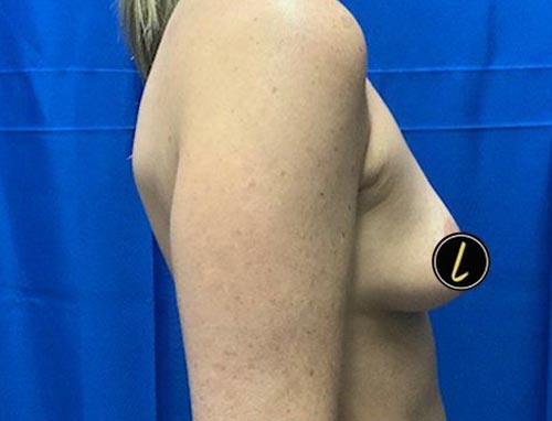 Breast Augmentation before and after - before