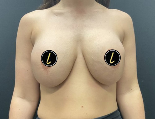 Breast Revision before and after - before
