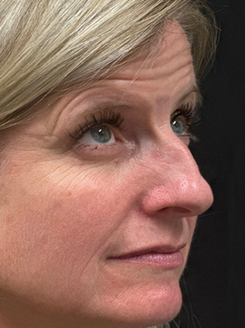 Rhinoplasty before and after - before