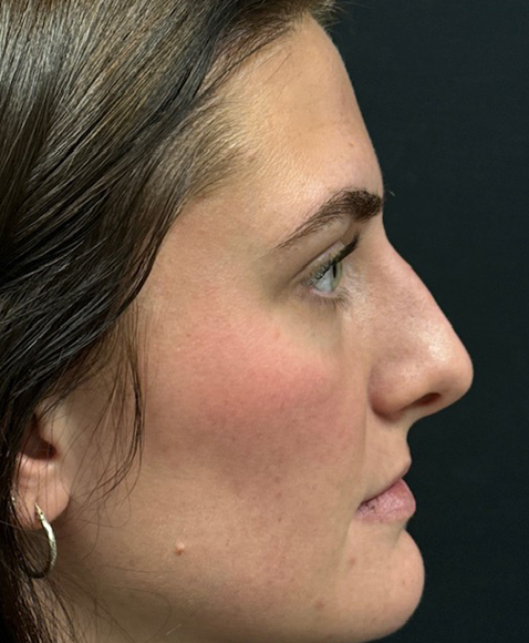 Rhinoplasty before and after - before