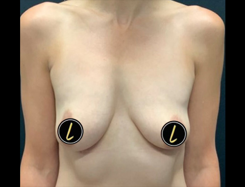 Breast Augmentation before and after - before