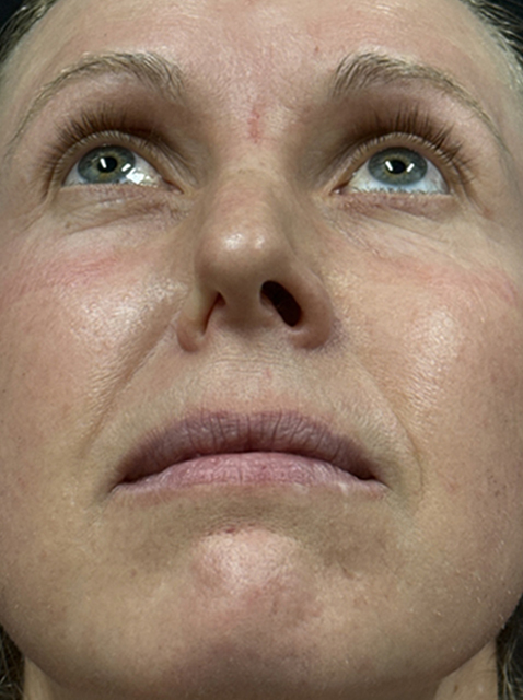 Rhinoplasty before and after - before