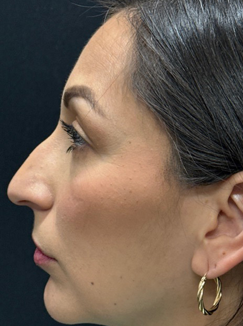 Rhinoplasty before and after - before