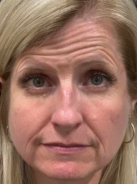 Rhinoplasty before and after - before