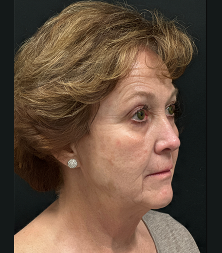 Facelift before and after - before
