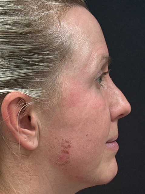 Rhinoplasty before and after - before