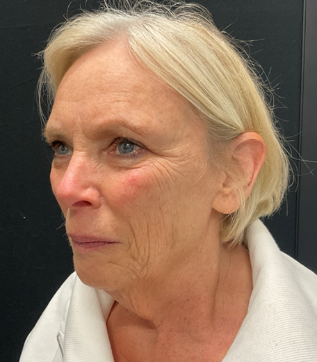 Facelift before and after - before