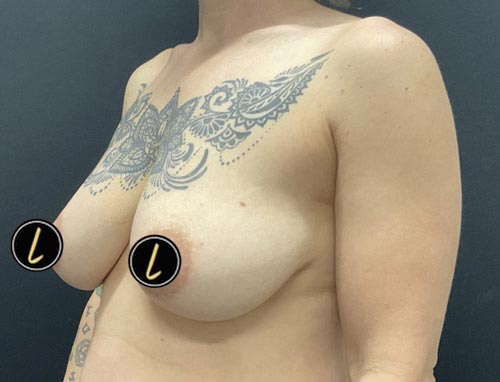 Breast Reduction before and after - before