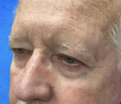 Male Blepharoplasty before and after - before