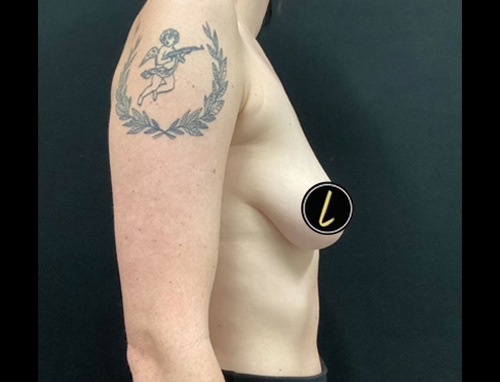 Breast Augmentation before and after - before