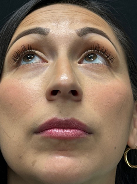 Rhinoplasty before and after - before