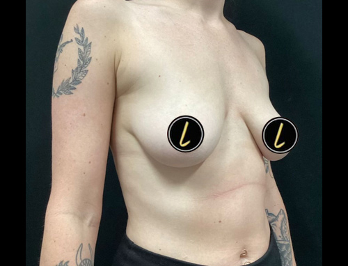 Breast Augmentation before and after - before