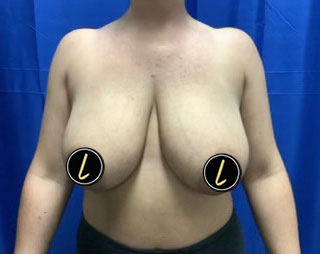 Breast Lift before and after - before