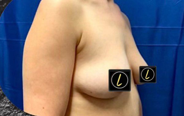 Breast Augmentation before and after - before