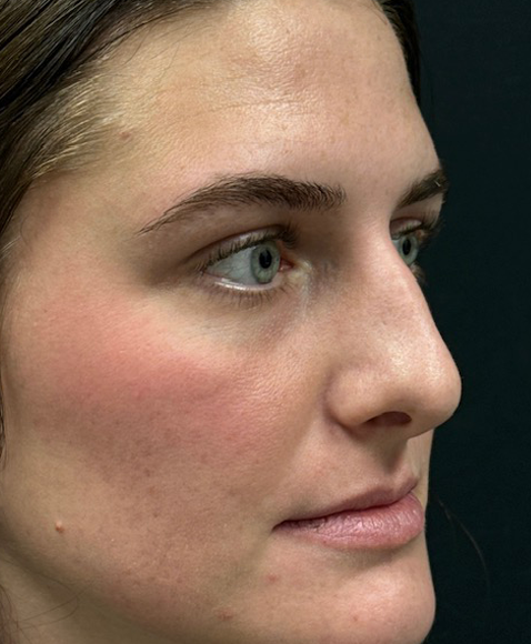 Rhinoplasty before and after - before