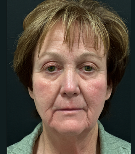 Facelift before and after - before