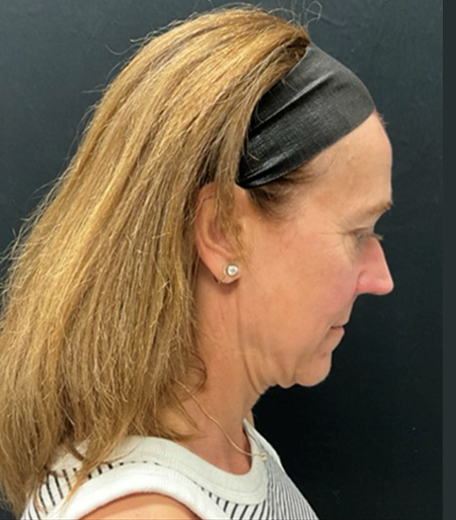 Facelift before and after - before