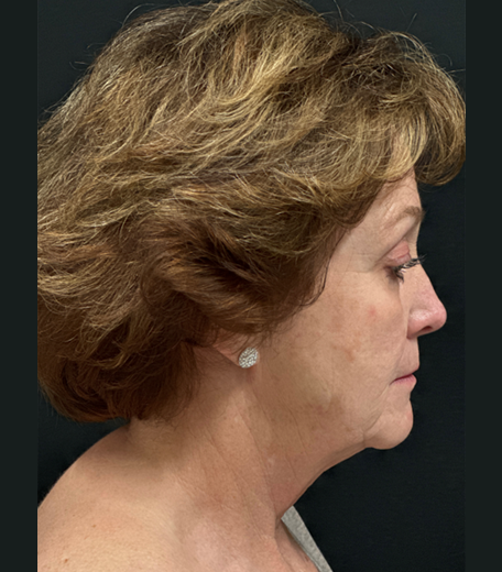 Facelift before and after - before