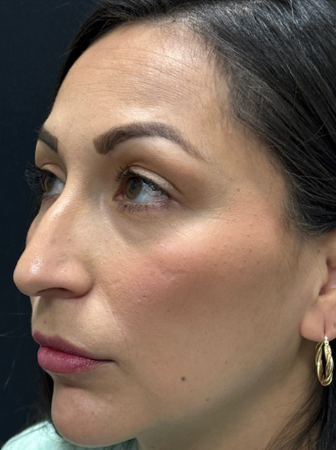 Rhinoplasty before and after - before