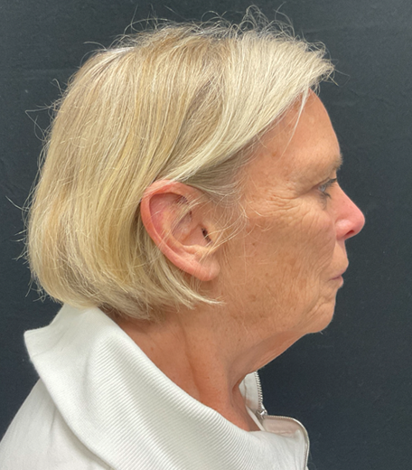 Facelift before and after - before