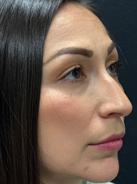 Rhinoplasty before and after - before