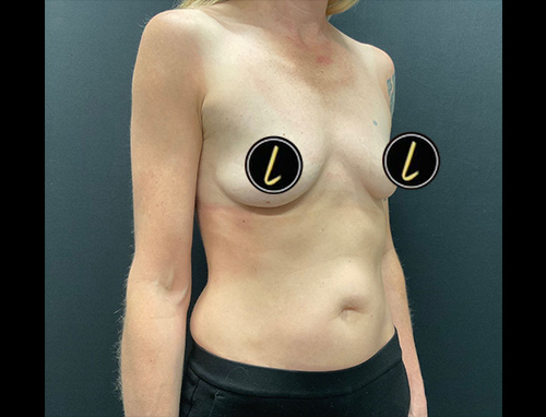 Breast Augmentation before and after - before