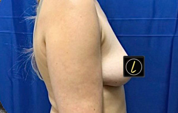 Breast Augmentation before and after - before