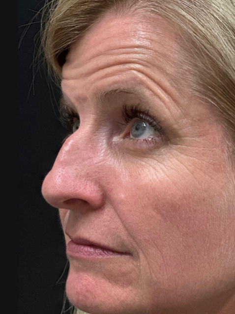Rhinoplasty before and after - before