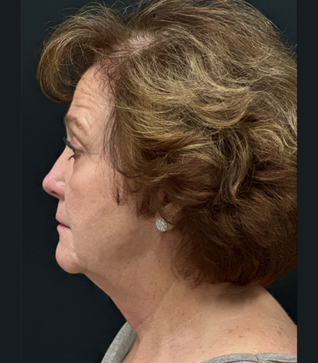 Facelift before and after - before