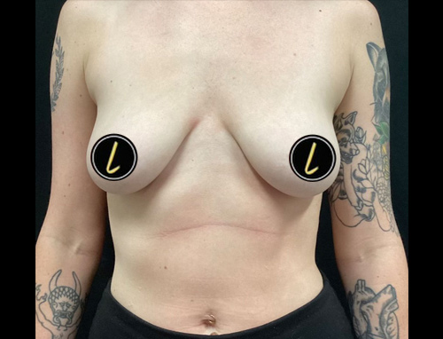 Breast Augmentation before and after - before