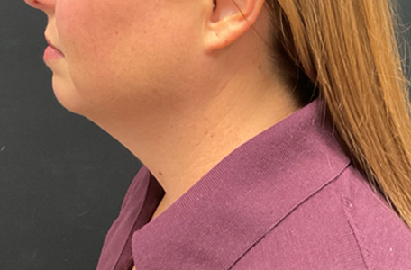 Facelift before and after - before
