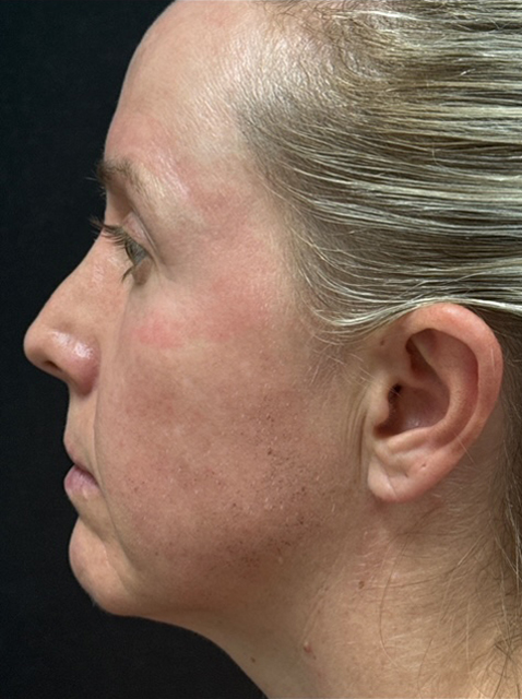 Rhinoplasty before and after - before