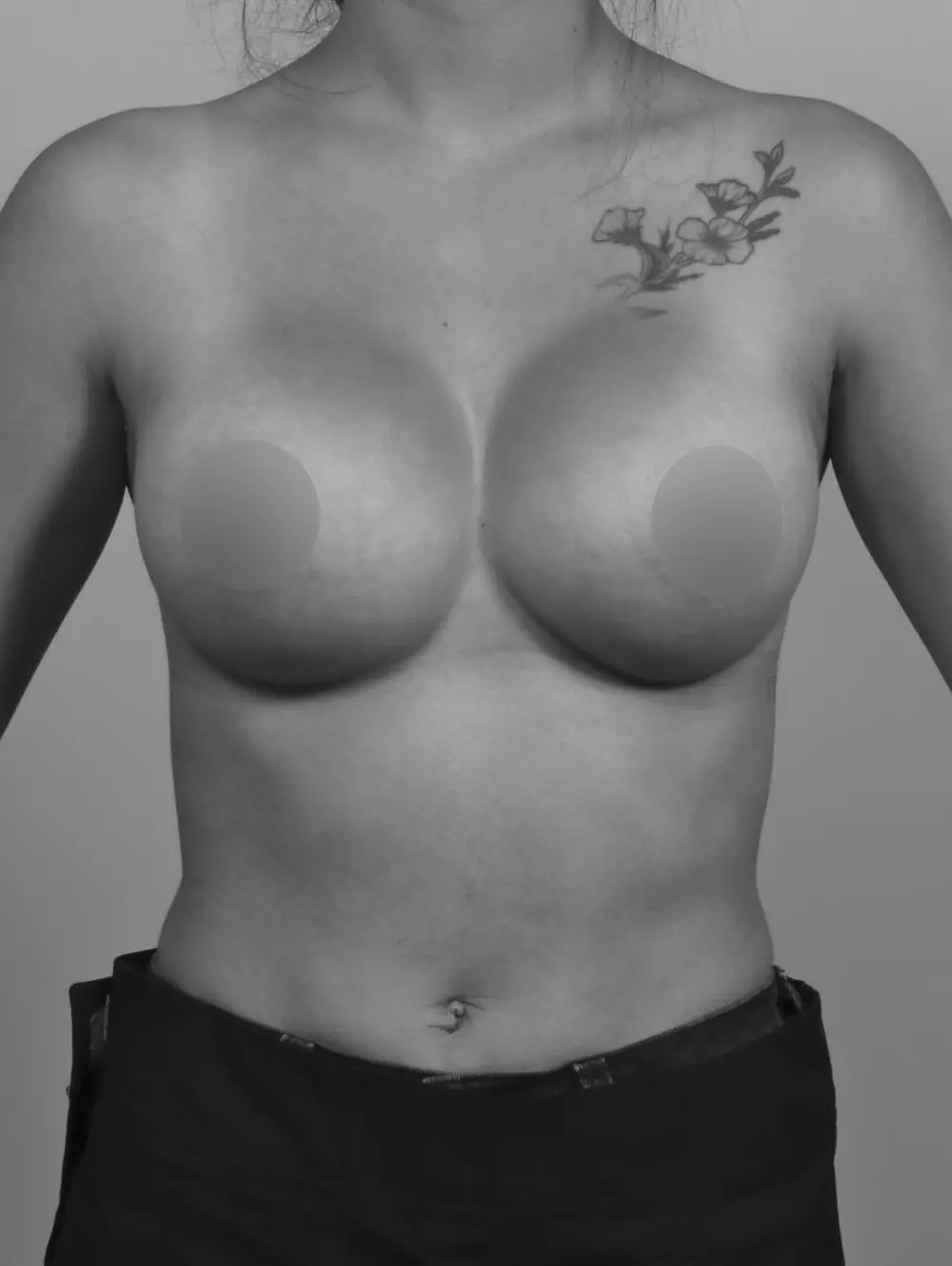 Breast Augmentation before and after - after