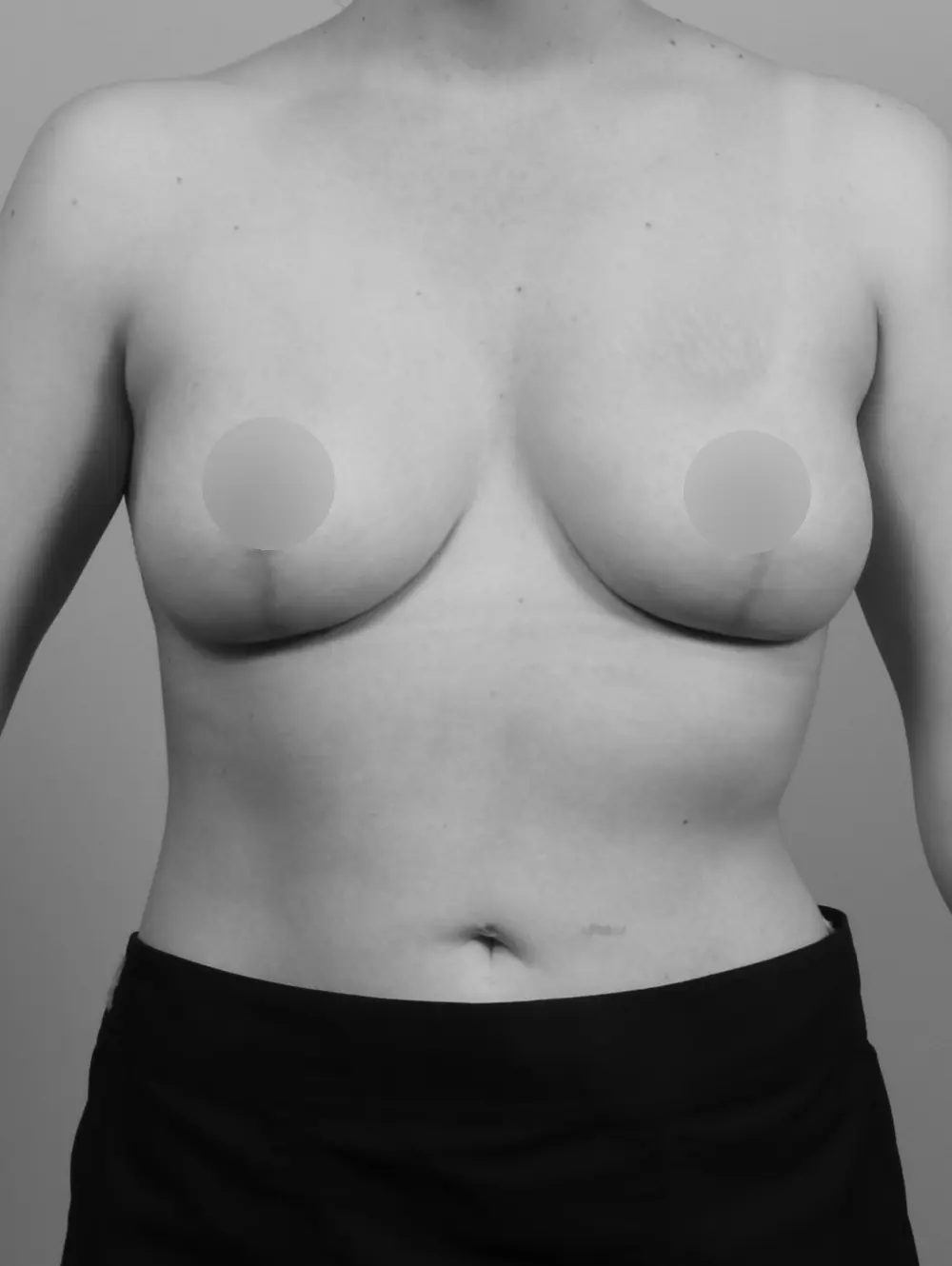 Breast Lift before and after - after